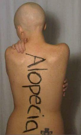 Alopecia Blue Ribbon for Alopecia Awareness Month